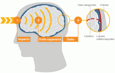 ¿Los golpes leves pueden dañar el cerebro?