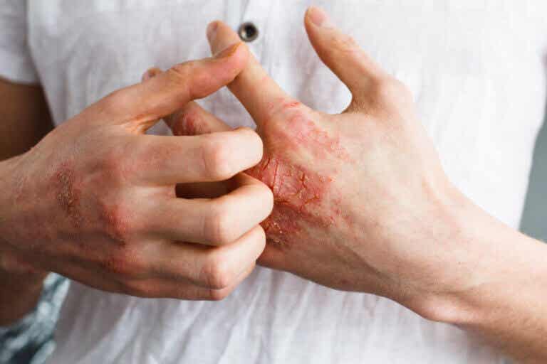Cómo aliviar los eczemas de manera natural