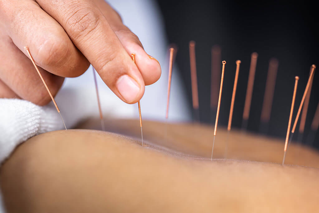 La acupuntura: Qué es y cuáles son sus beneficios