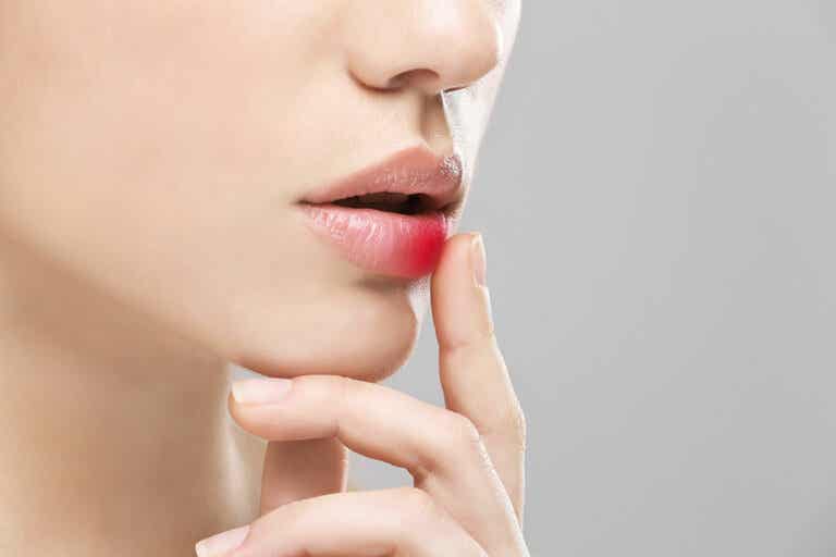 Prevenir el herpes labial es mejor que tratarlo