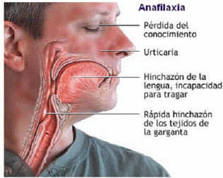 Cómo actuar ante un shock anafiláctico