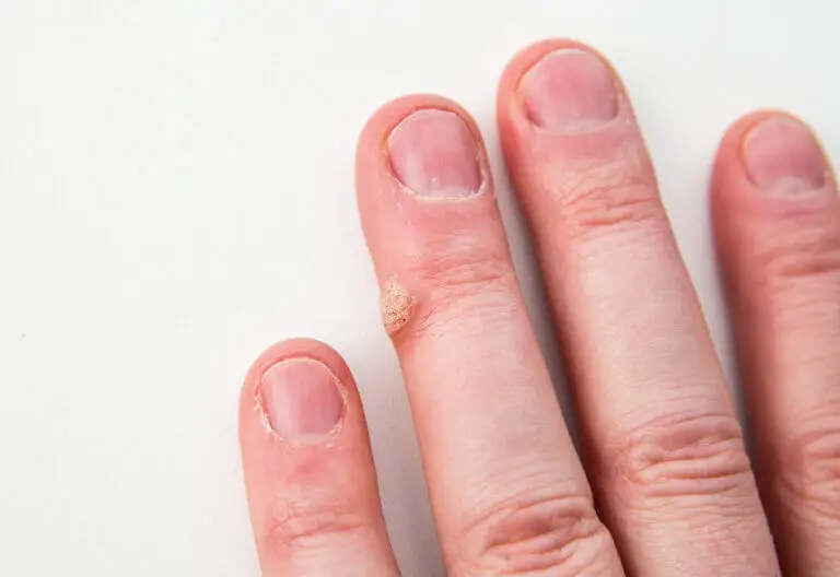 ¿Es posible quitar las verrugas de forma natural?