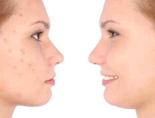 Acne