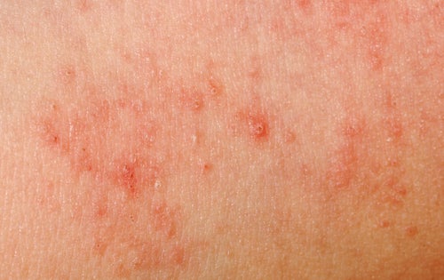 Alergias en la piel