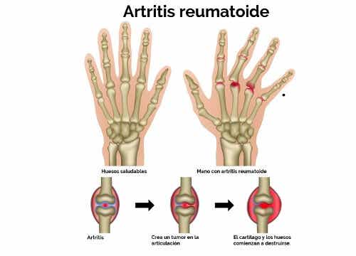El alivio de la artritis está en la naturaleza