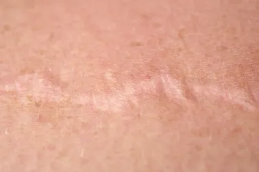 Cómo utlizar la cebolla para tratar las cicatrices