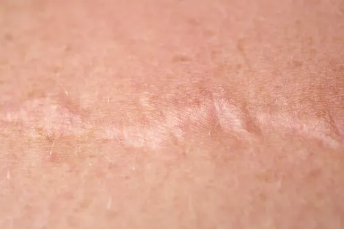 Cicatrices de la piel