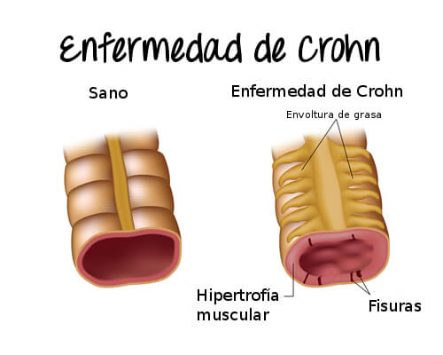 Enfermedad de Crohn: síntomas y tratamiento