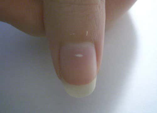 ¿Qué significan las manchas blancas en las uñas?