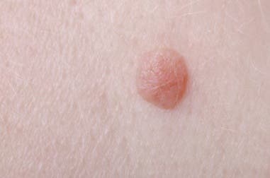7 tratamientos para desaparecer las verrugas planas