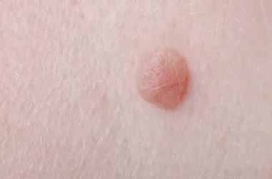 7 tratamientos para desaparecer las verrugas planas