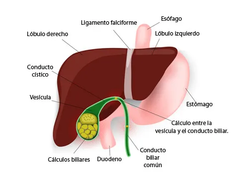 Dietas bajas en calorías y cálculos en la vesícula