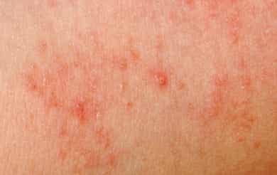Las 10 alergias de la piel más comunes