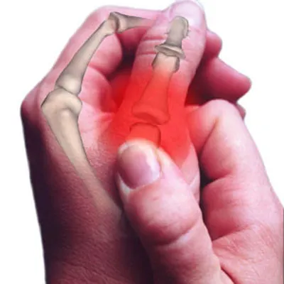 Artrosis pulgar