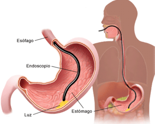 Endoscopia: ¿para qué sirve y cómo funciona?
