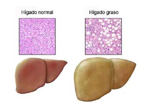 Hígado graso: Alimentos que se deben evitar
