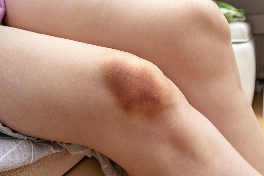 Ehlers-Danlos-Syndrom - Knie mit Bluterguss