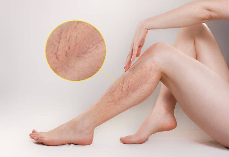 Los 11 mejores remedios para tratar las varices
