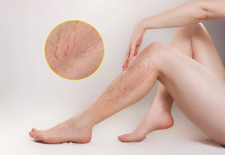 Los 11 mejores remedios para tratar las varices