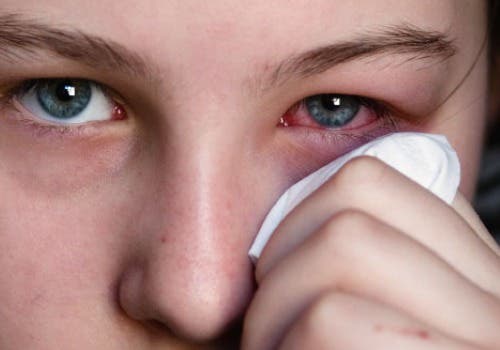 Persona con ojos rojos