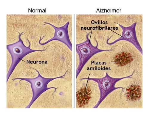 Alimentos que nos protegen del Alzhéimer: ¿mito o realidad?