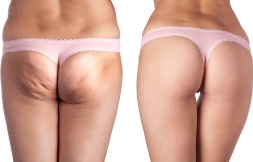 ¿Pueden ser eficaces los tratamientos naturales contra la celulitis?