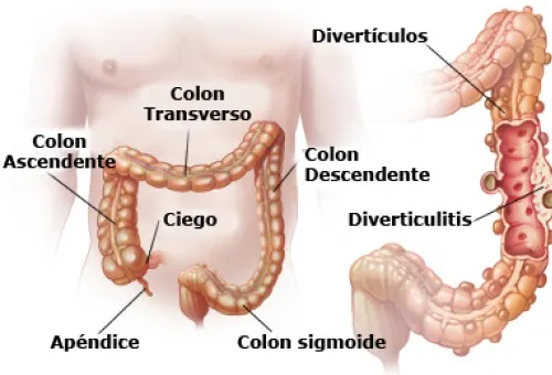 Qué son y cómo tratar la diverticulosis y la diverticulitis