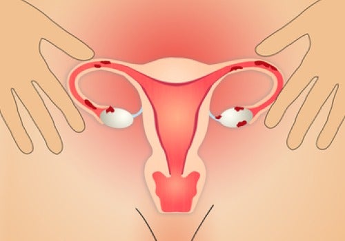 Endometriosis, tratamiento médico y terapias naturales