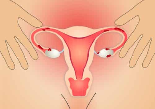 Endometriosis, tratamiento médico y terapias naturales