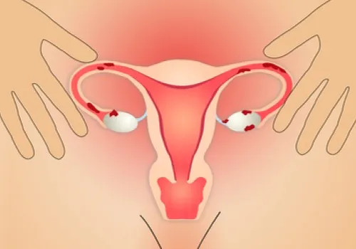 Endometriosis, tratamiento médico y terapias naturales