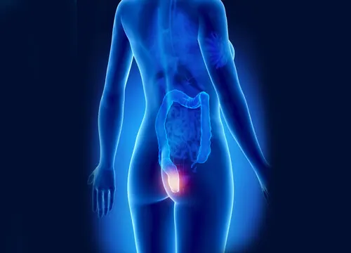 9 remedios naturales contra las hemorroides rectales