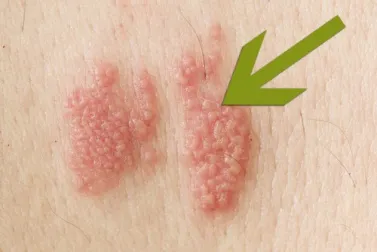 La culebrilla: ¿qué es y cómo se manifiesta?