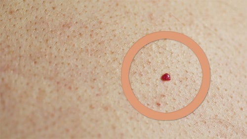 Los lunares rojos o lunares de sangre en la piel no son lo mismo que los puntos.