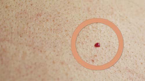 Los lunares rojos o lunares de sangre en la piel no son lo mismo que los puntos.