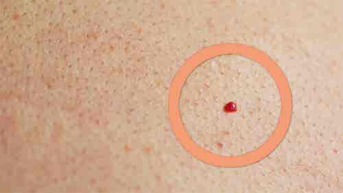 Lunares rojos en la piel: ¿A qué se deben?
