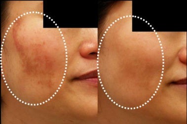 3 Tratamientos Para Reducir Las Manchas Por Melasma Mejor Con Salud