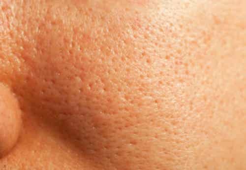 Tratamiento natural para los poros dilatados