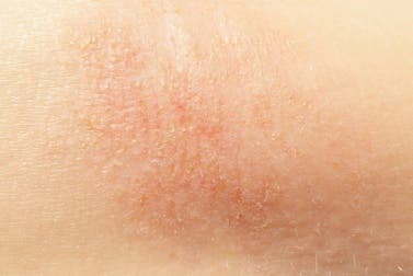 7 remedios naturales para la piel reseca