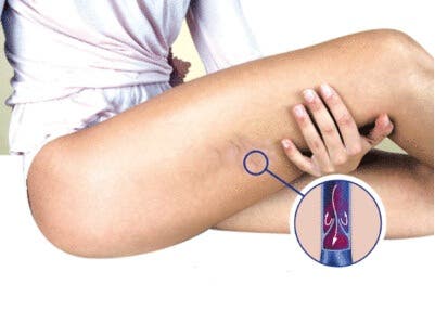Ejercicios para evitar y tratar las varices