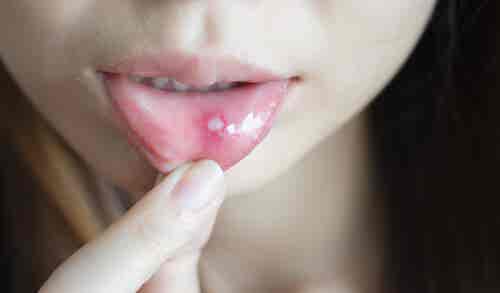 ¿Cómo curar aftas y llagas en la boca?
