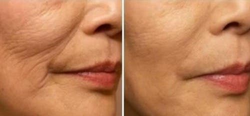 Tratamientos naturales para evitar las arrugas