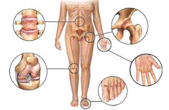 Imagen de las articulaciones más afectadas por la artritis