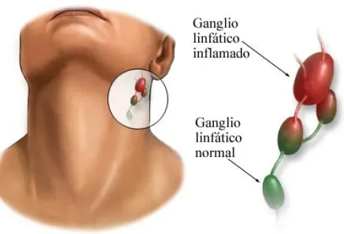 Ganglios linfáticos