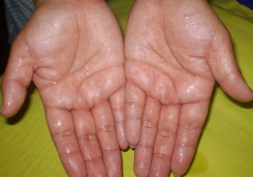 Sudoración en las manos: causas y remedios para tratarla