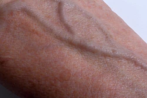 El melasma o paño en la piel.