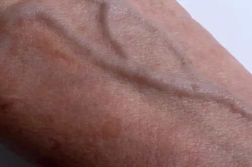 El melasma o paño en la piel.