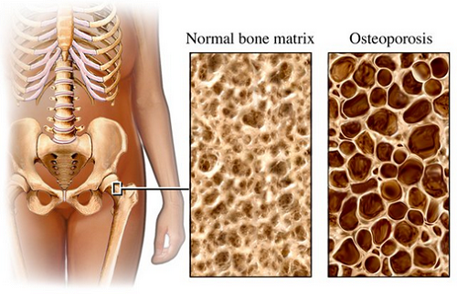 Todo lo que debes saber sobre la osteoporosis