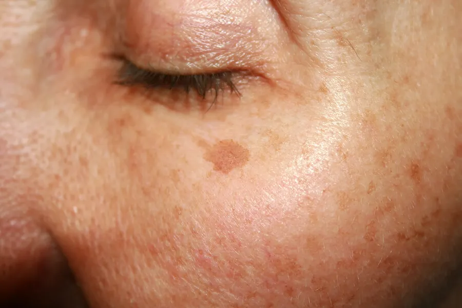 Melasma y manchas solares.