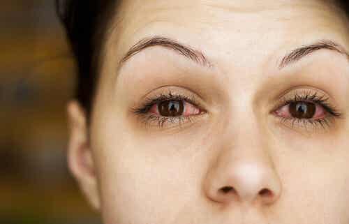 Kobiet z czerwonymi oczami. Jak chronić oczy przed zimnem?