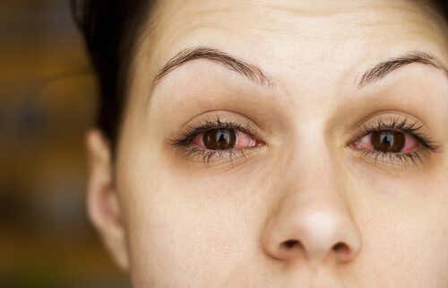 Kvinde har røde øjne og bør beskytte øjnene mod kulde